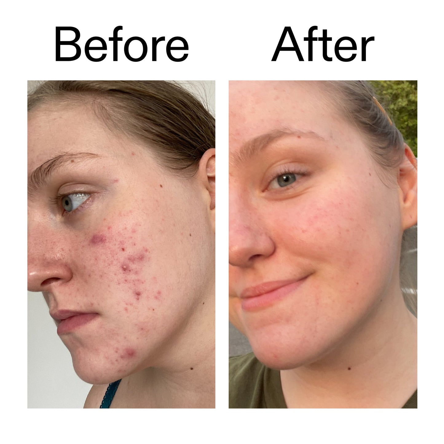 glycolic-acid-toner-c3 Glycolic_Acid_Toner_Before_After_2000x2000_49f0b9f7-e71b-4b2e-a8f8-2ea4b73247bb.jpg