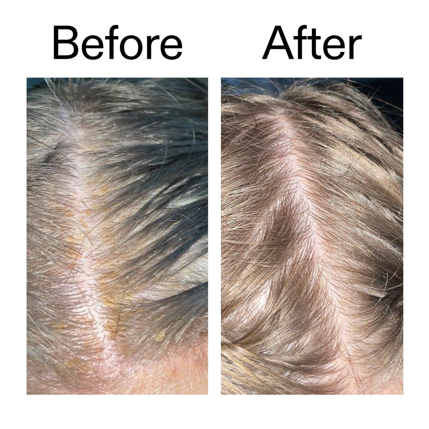 salicylic-acid-exfoliating-scalp-treatment-m9 Salicylic_Acid_Exfoliating_Scalp_Treatment_Before_After_2000x2000_e572a30f-057c-4a48-823b-1c09dc97f8d0.jpg