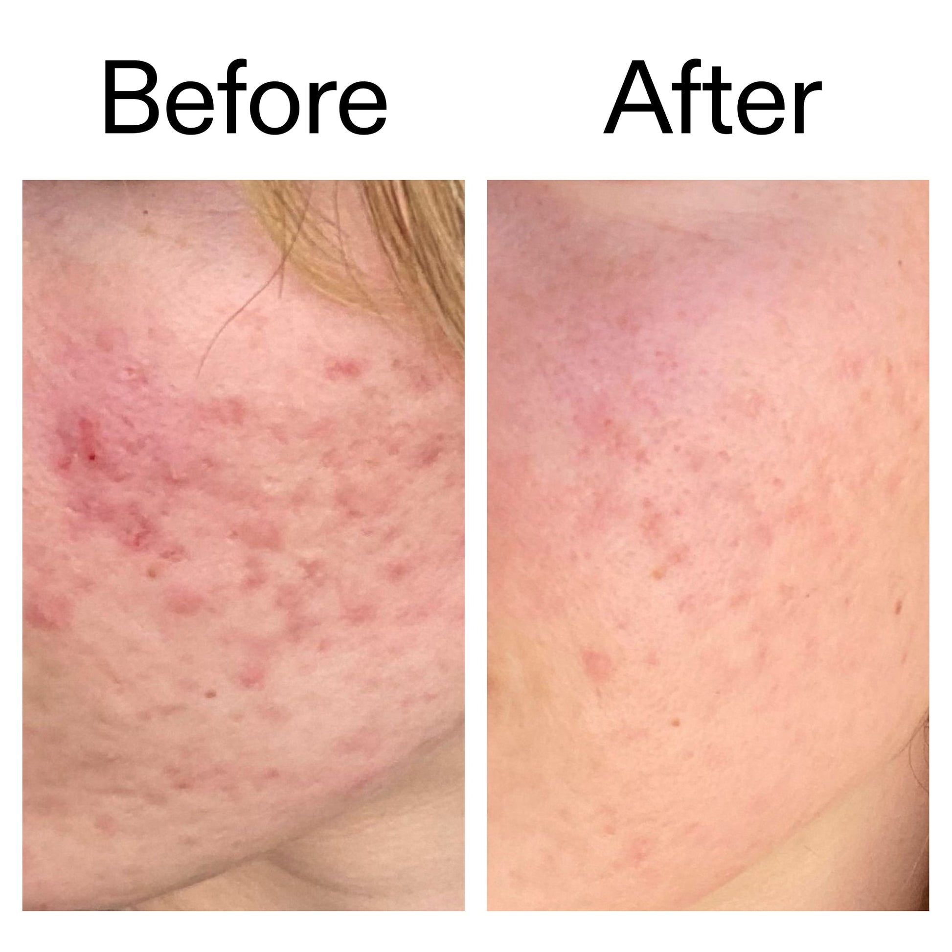 10-azelaic-acid-serum-for-redness-relief-p9 Azealic_Acid_Serum_B_A_Ppage_2000_x_2000.jpg
