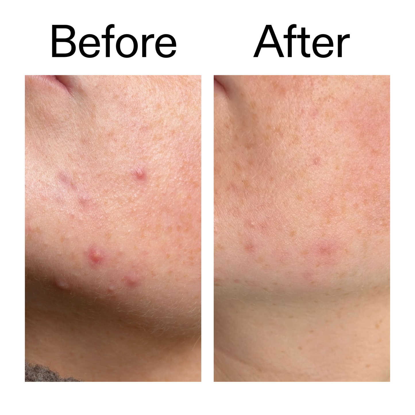 10-azelaic-acid-serum-for-redness-relief-p9 B_A_1_PPAGE.png