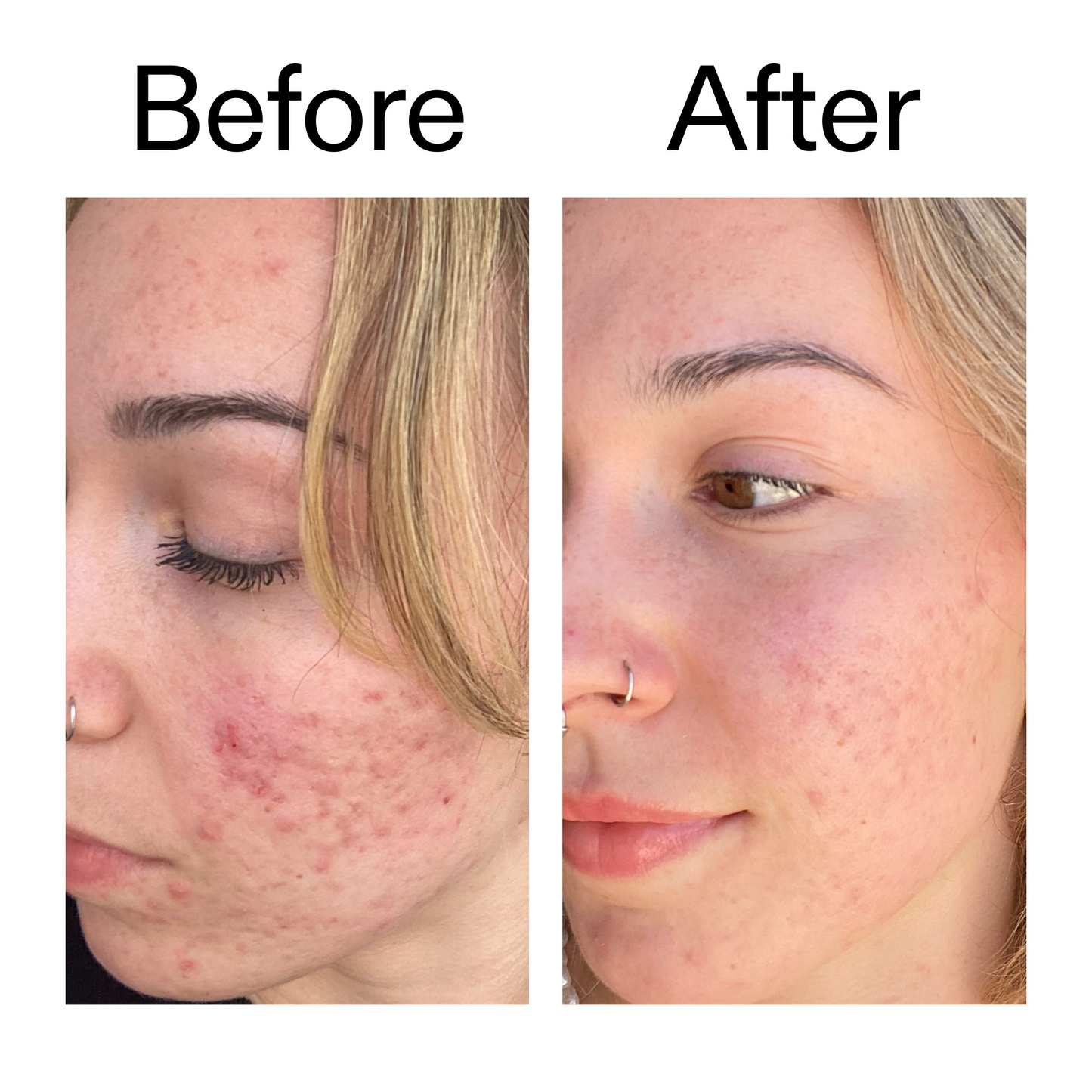 10-azelaic-acid-serum-for-redness-relief-p9 B_A_2_PPAGE.png