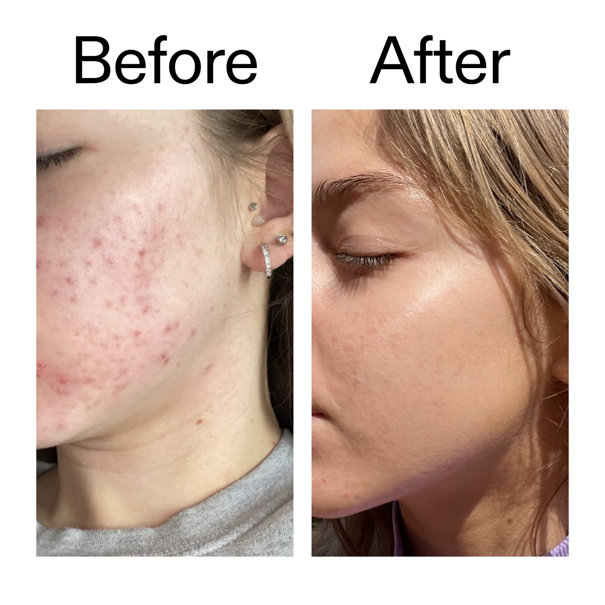 beta-hydroxy-acid-bha-serum-j5 Beta_Hydroxy_Acid_Serum_Before_After_2000x2000_96fda3e5-938d-49ef-bcf2-a0fa6ece4e2c.jpg