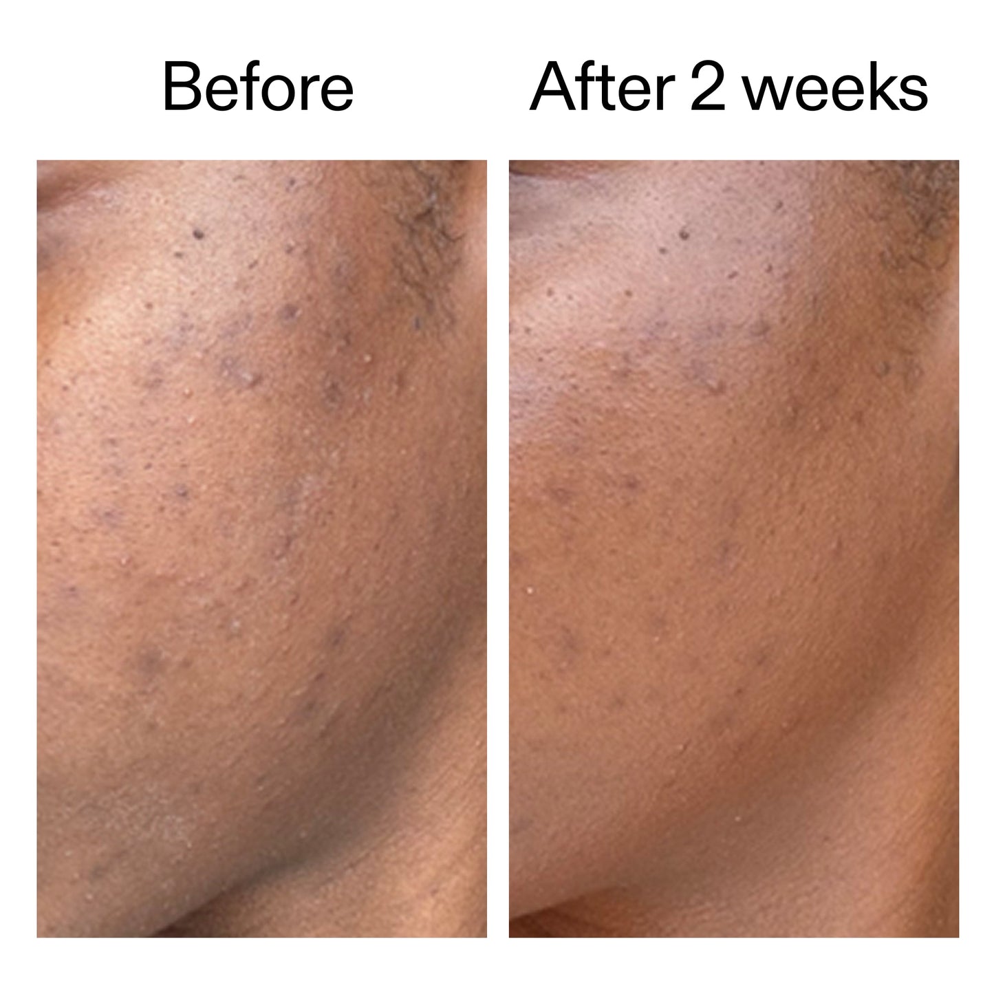 360-acne-clearing-duo-q7 DIOICB_A2000x2000.jpg