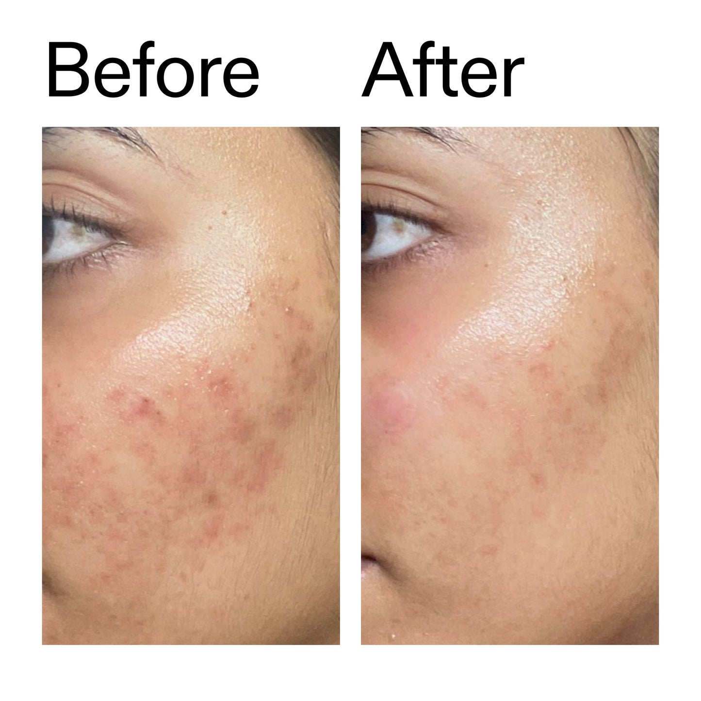 ectoin-hydro-barrier-serum-duo-x6 Ectoin_Hydro-barrier_Serum__Before_After_2000x2000_34261920-d004-48d0-9c7b-8e1c15971bfd.jpg