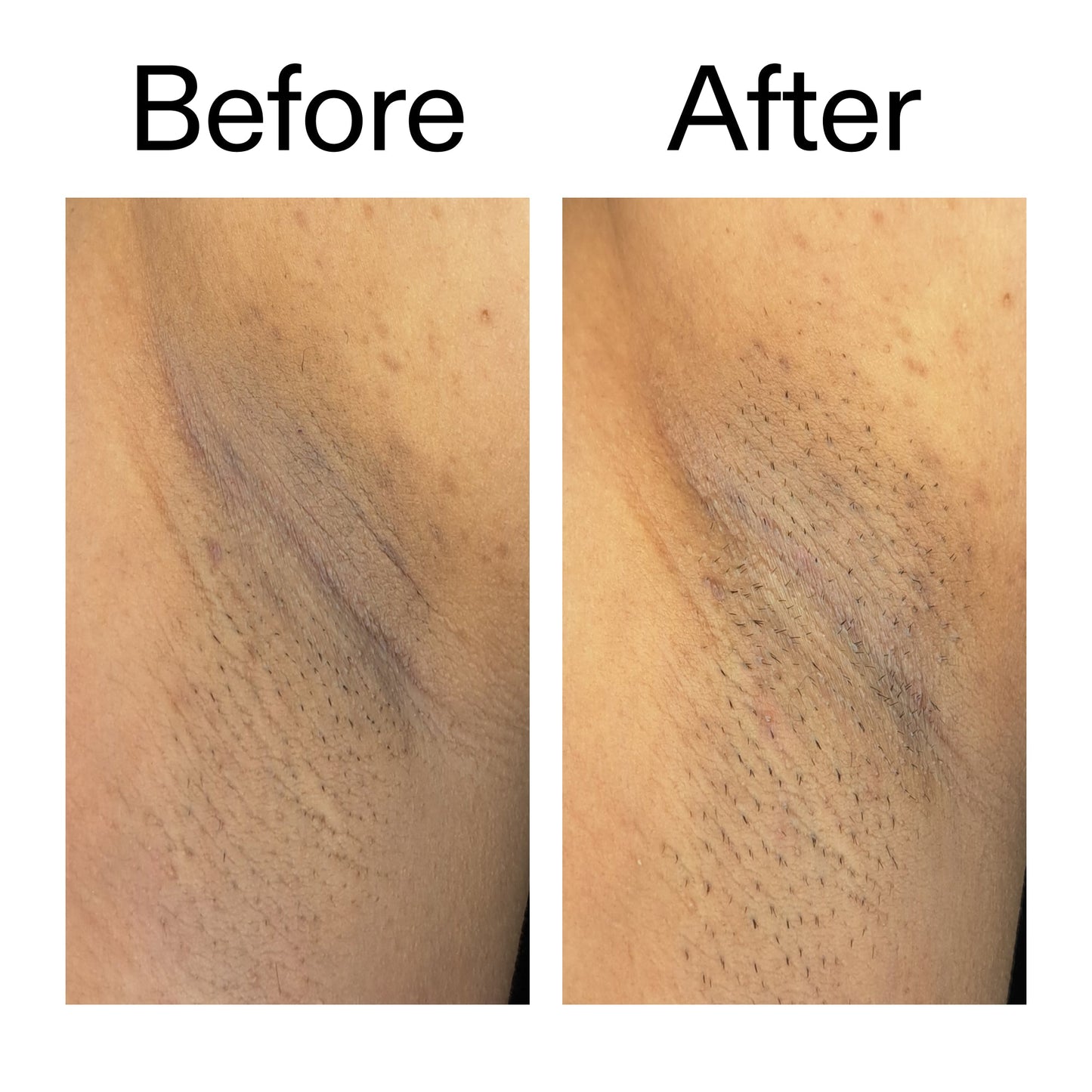 glycolic-acid-exfoliating-body-stick-m2 Glycolic_Acid_Exfoliating_Body_Stick_Before_After_V3_2000x2000_ea919cd9-1439-4a46-82a0-76200eb5bb42.jpg