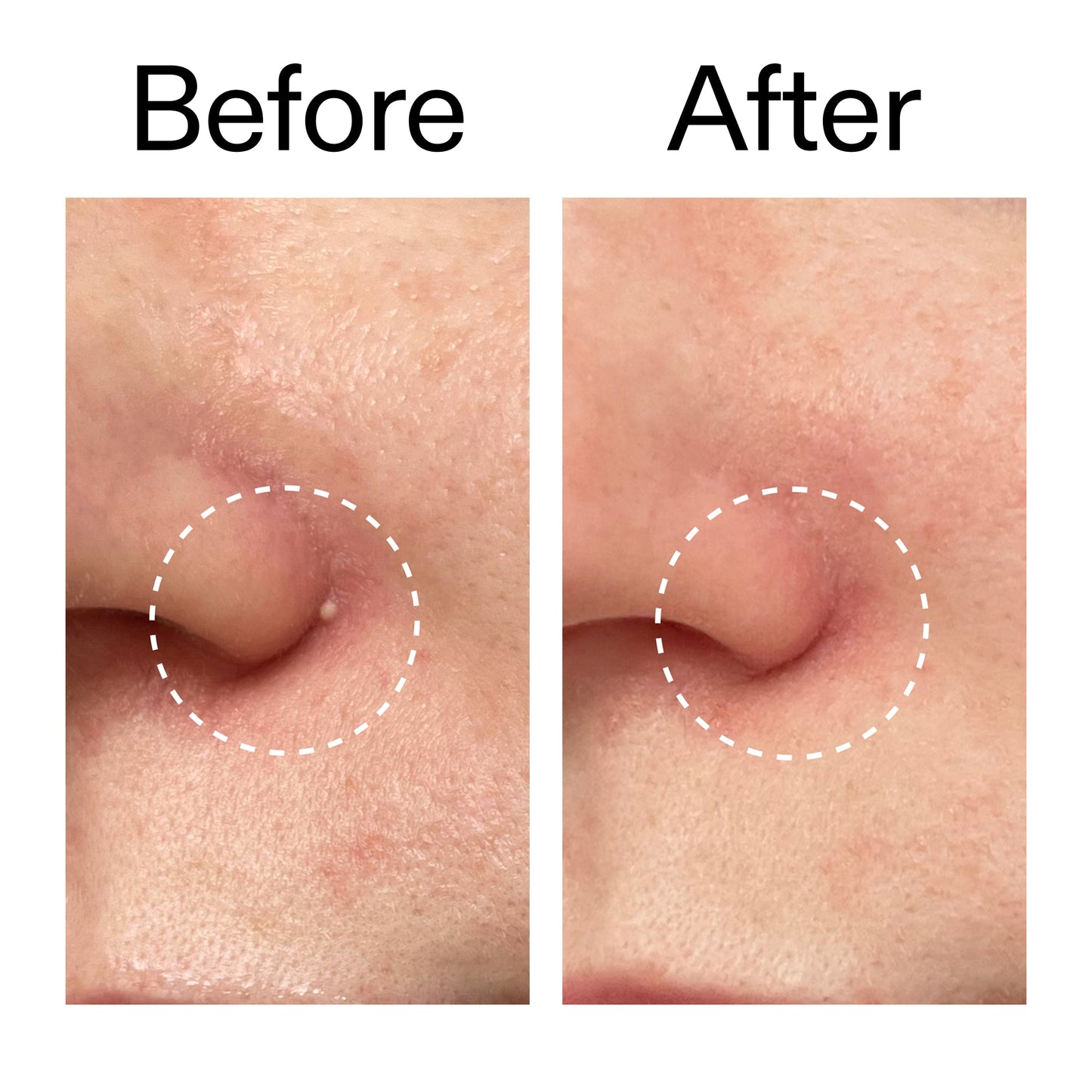 hydrocolloid-invisible-pimple-patches-pack-of-44-b8 Hydrocolloid_Invisible_Pimple_Patches_Before_After_2000x2000_b02aa37b-c78a-4682-91de-9135af5bb7df.jpg