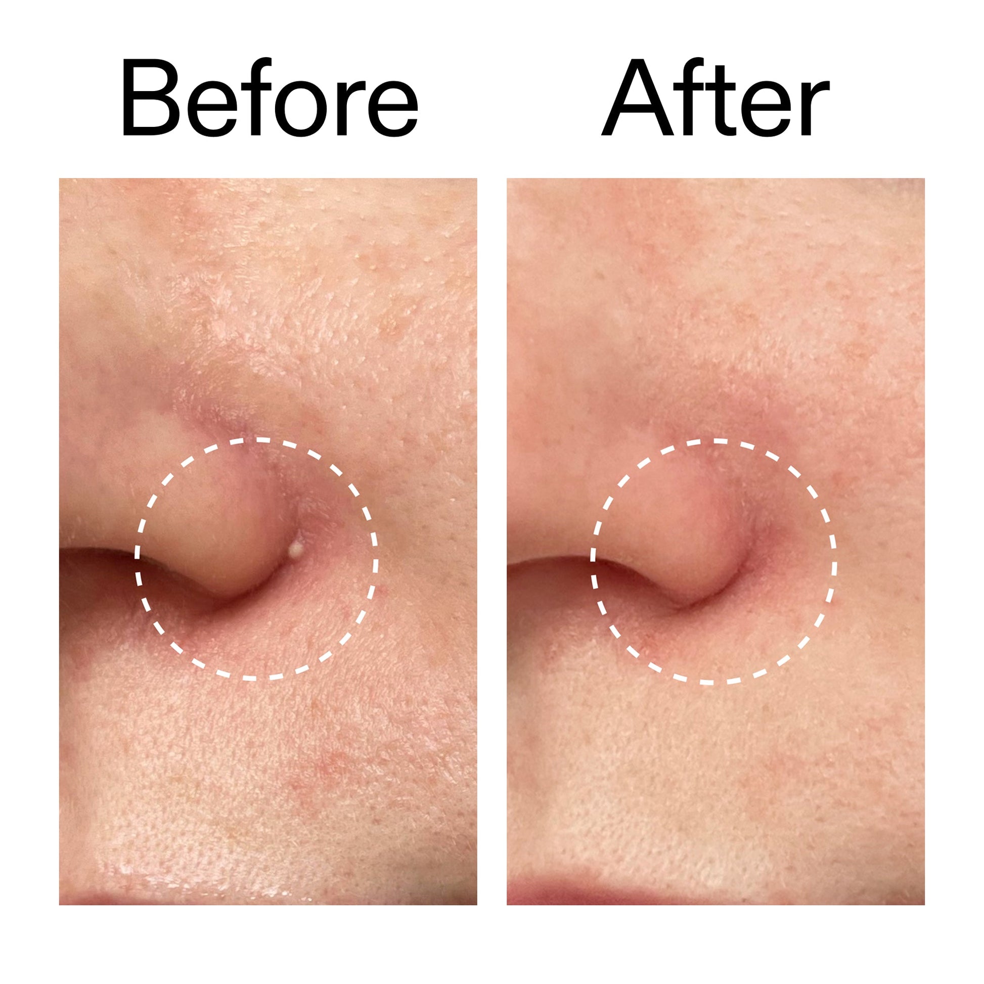 hydrocolloid-invisible-pimple-patches-pack-of-44-b8 Hydrocolloid_Invisible_Pimple_Patches_Before_After_2000x2000_b02aa37b-c78a-4682-91de-9135af5bb7df.jpg
