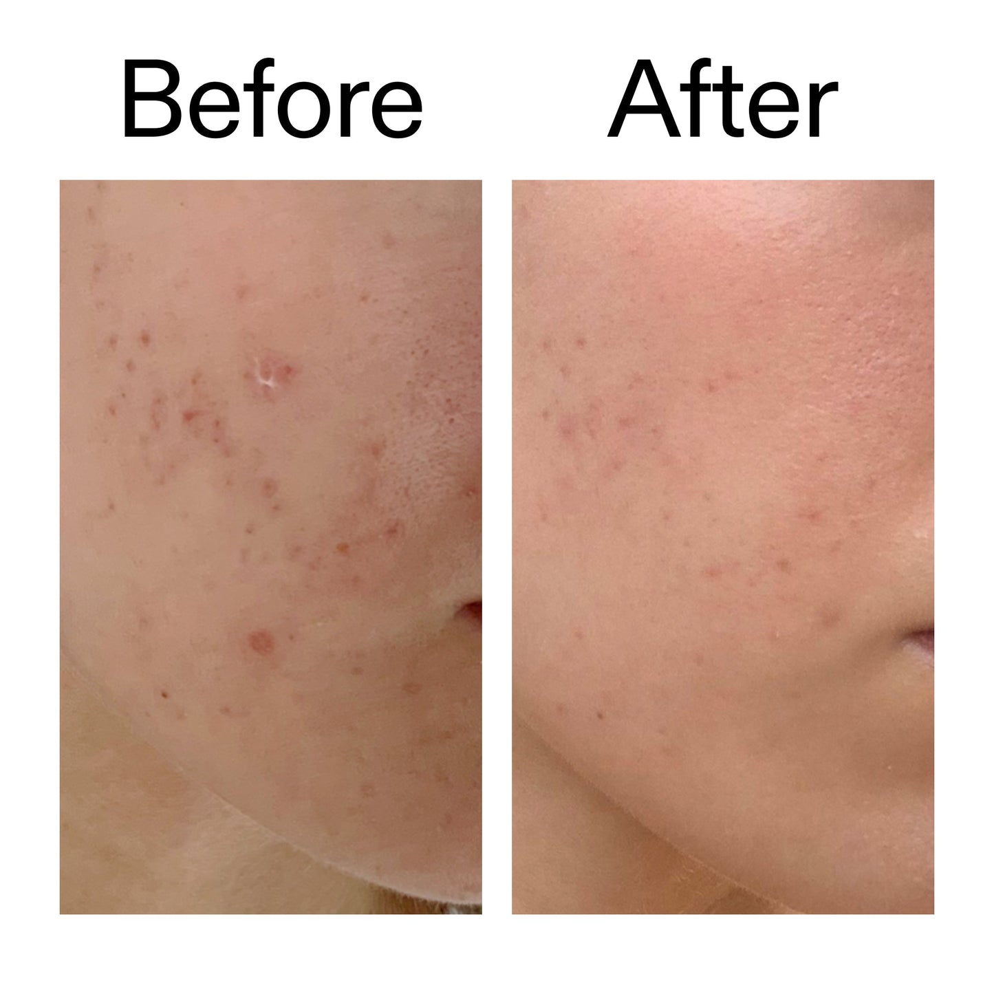 mandelic-acid-treatment-j9 Mandelic_Acid_Treatment_Before_After_2000x2000_4885ac6e-c5d7-4279-a72a-1417af7dce35.jpg