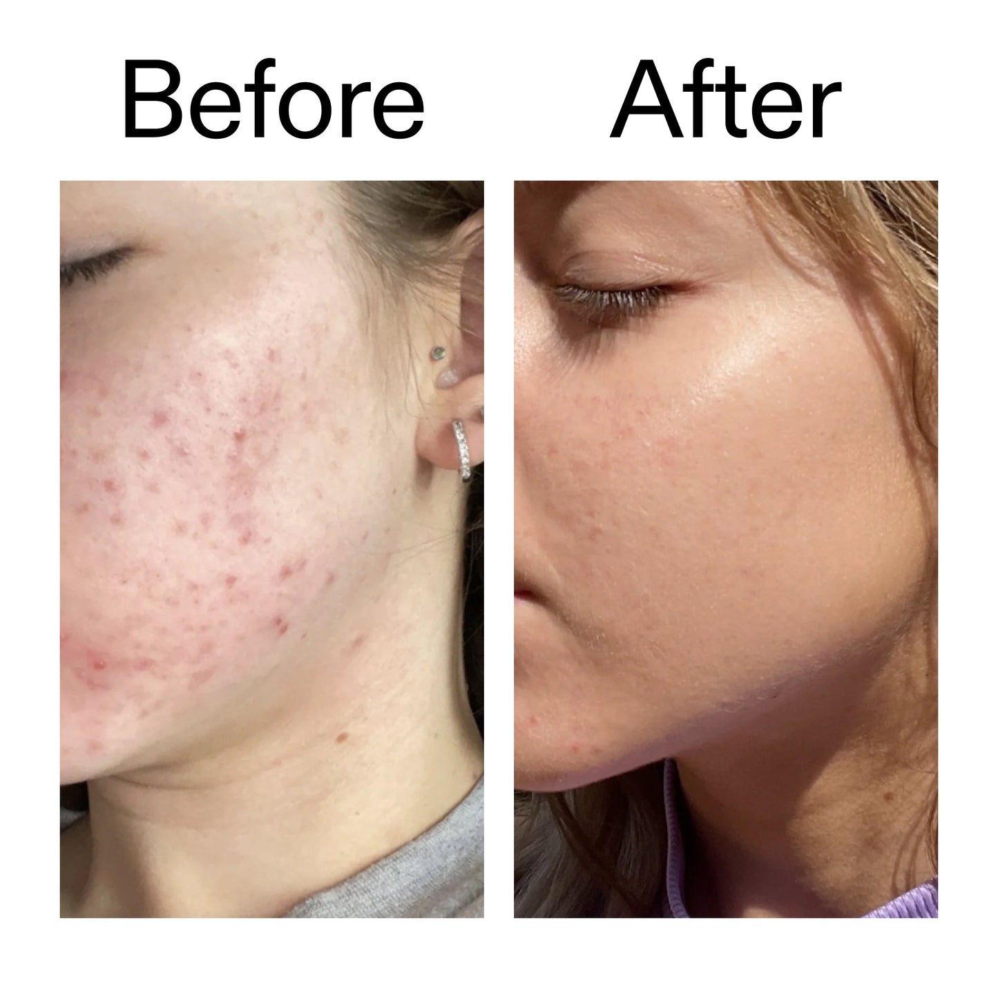10-niacinamide-serum-duo-d9 Niacinamide_Serum_Before_After_2000x2000_bde32455-9e7d-448e-b053-bef41504f0a9.jpg