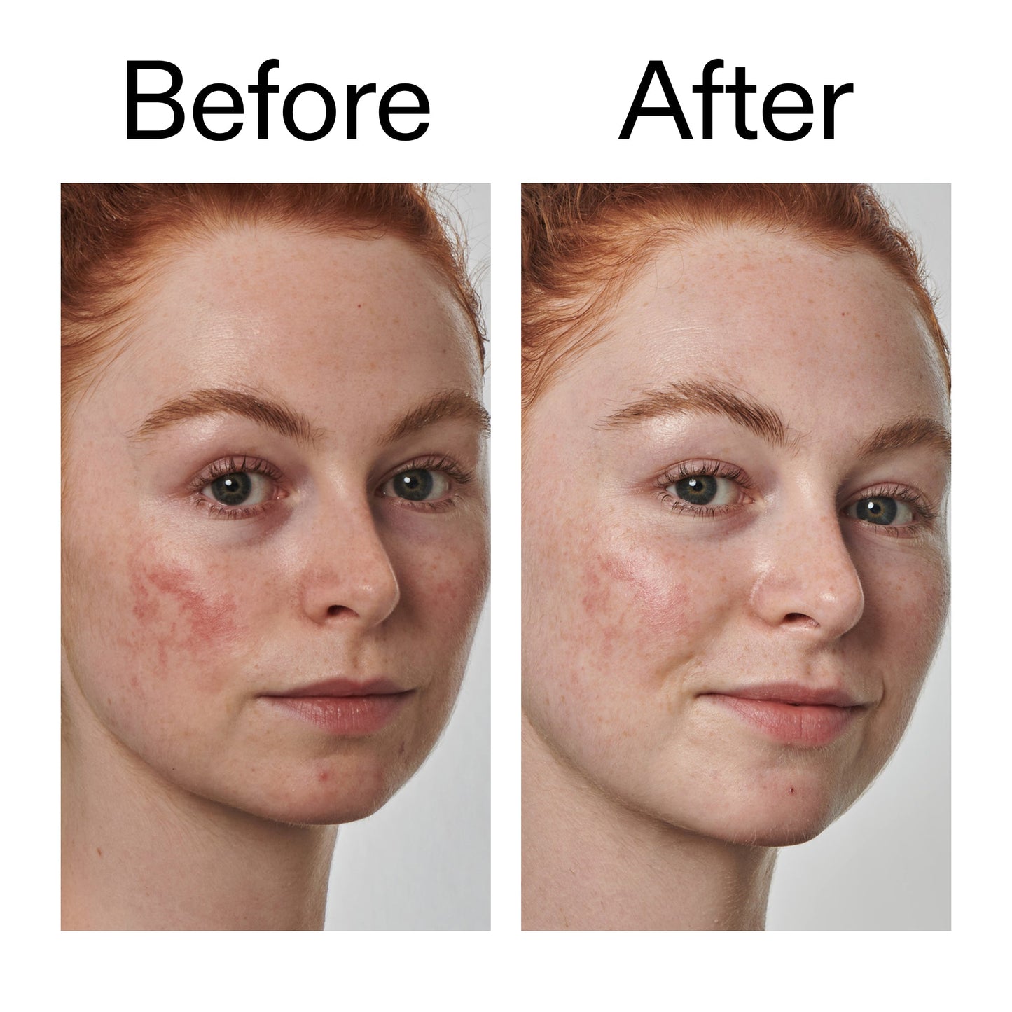 10-azelaic-acid-serum-for-redness-relief-p9 Redness_Relief_Serum_Before_After_2000x2000_3334dc9a-cce9-4e00-8aec-7ad89ca051f2.jpg