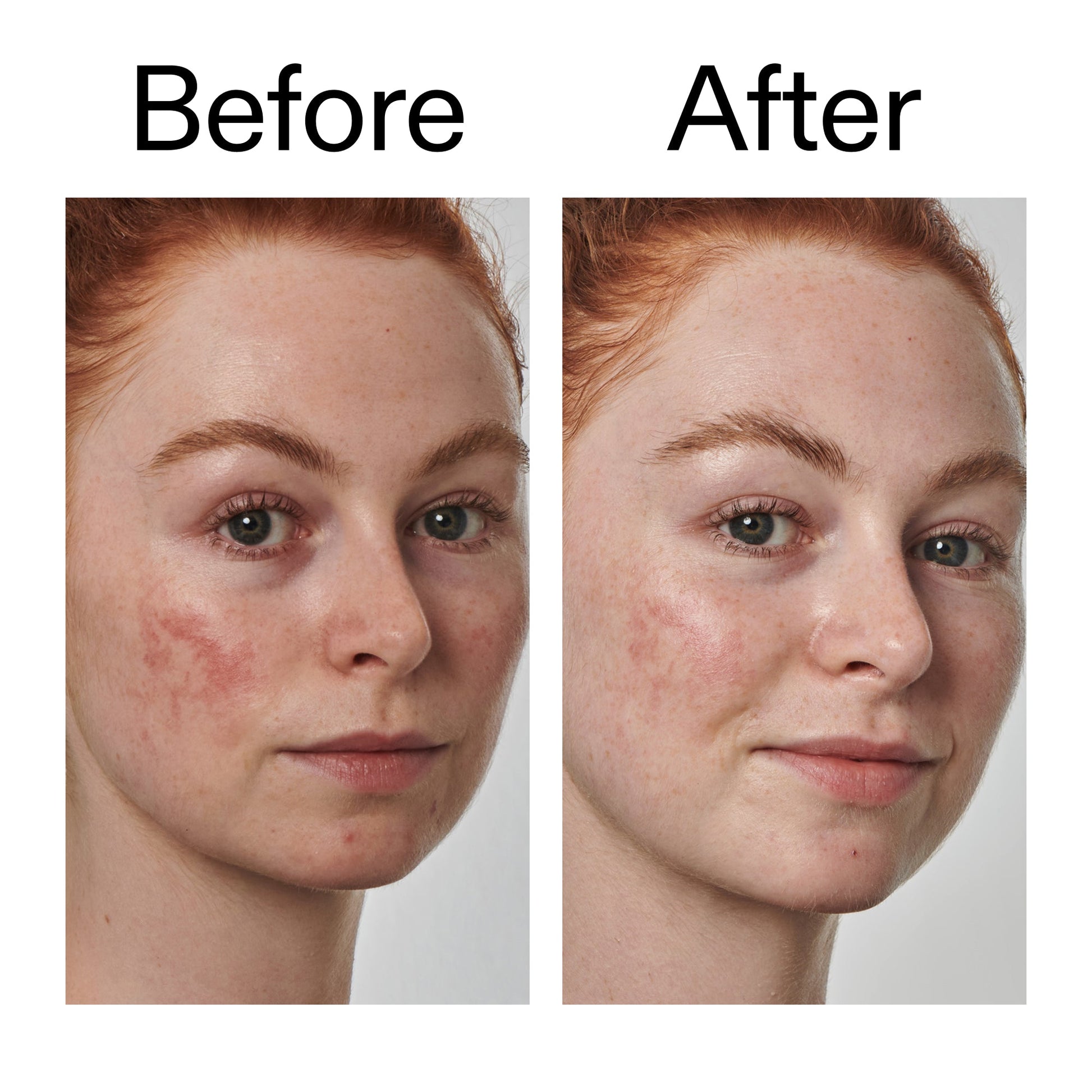 10-azelaic-acid-serum-for-redness-relief-p9 Redness_Relief_Serum_Before_After_2000x2000_3334dc9a-cce9-4e00-8aec-7ad89ca051f2.jpg