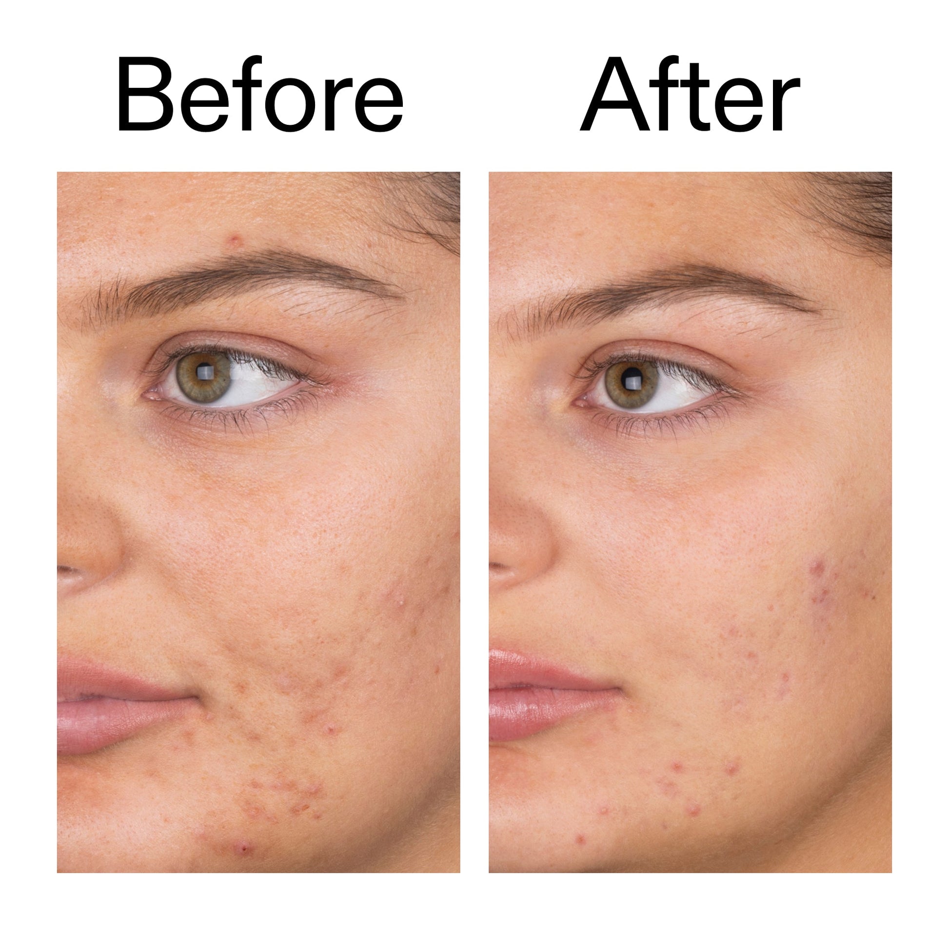 salicylic-acid-cleanser-duo-i5 Salicylic_Acid_Cleanser_-_150ml_Before_After_2000x2000_e7230494-853f-4b07-82b1-27669104c995.jpg