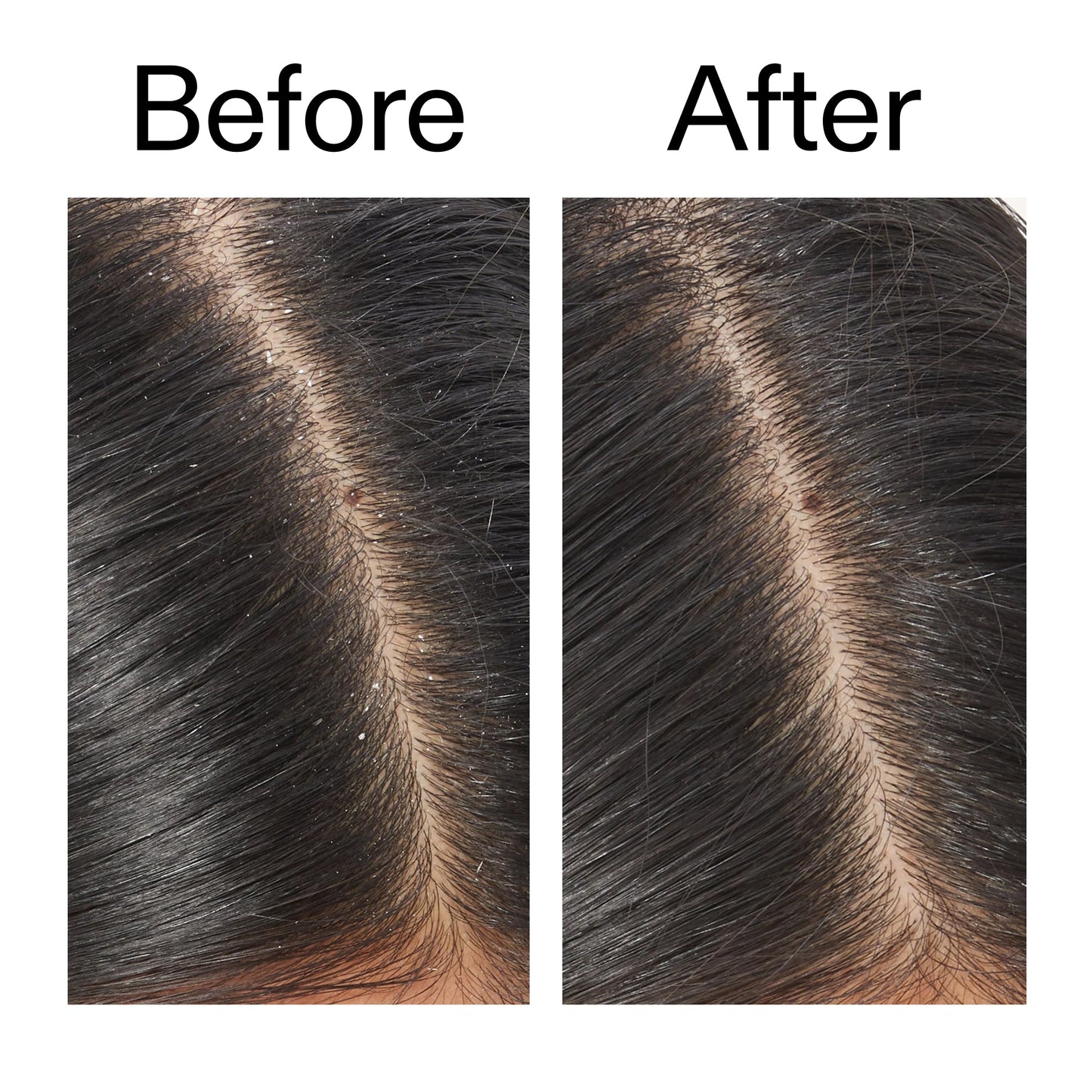 salicylic-acid-exfoliating-scalp-treatment-m9 Salicylic_Acid_Exfoliating_Scalp_Treatment_Before_After_V2_2000x2000_02bd61ad-42bf-490b-b3e3-7e04b2e8a673.jpg