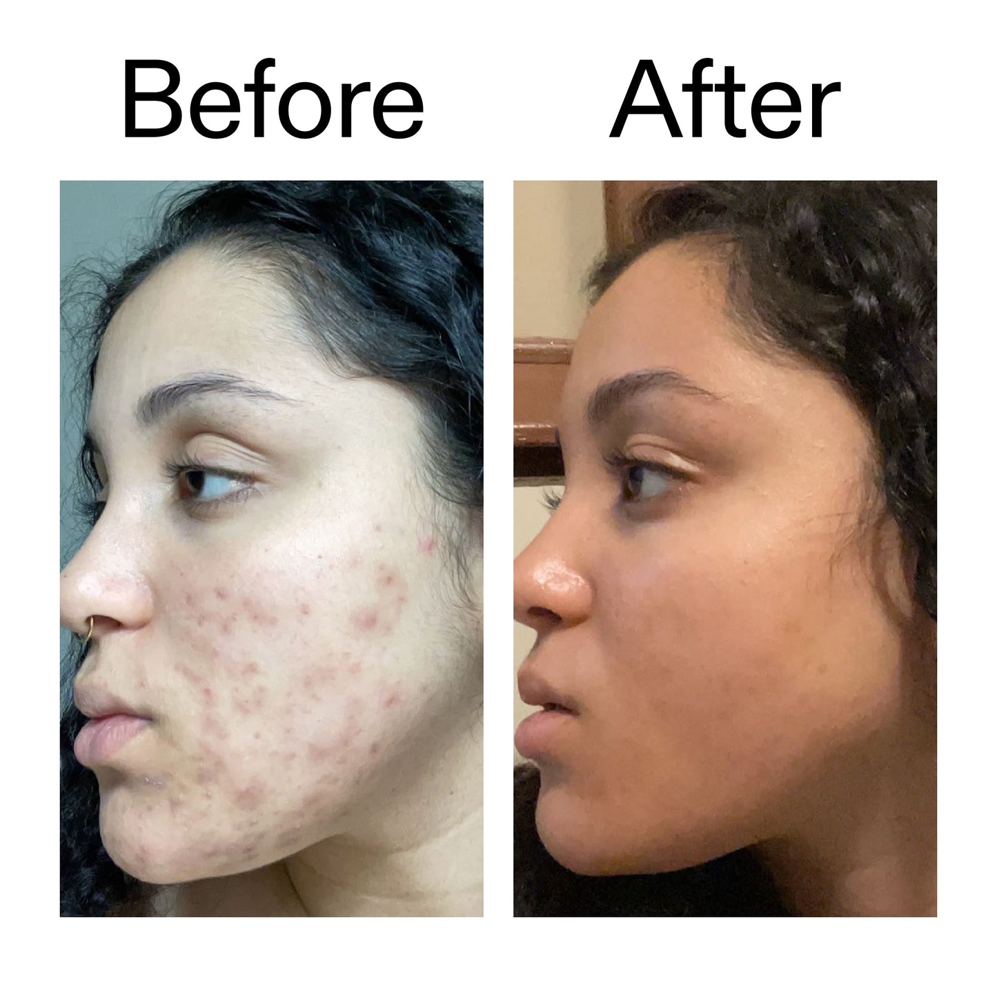 tranexamic-acid-serum-t7 Tranexamic_Acid_Serum_Before_After_2000x2000_98ebc8be-77b0-4843-8a22-90790ebe918b.jpg